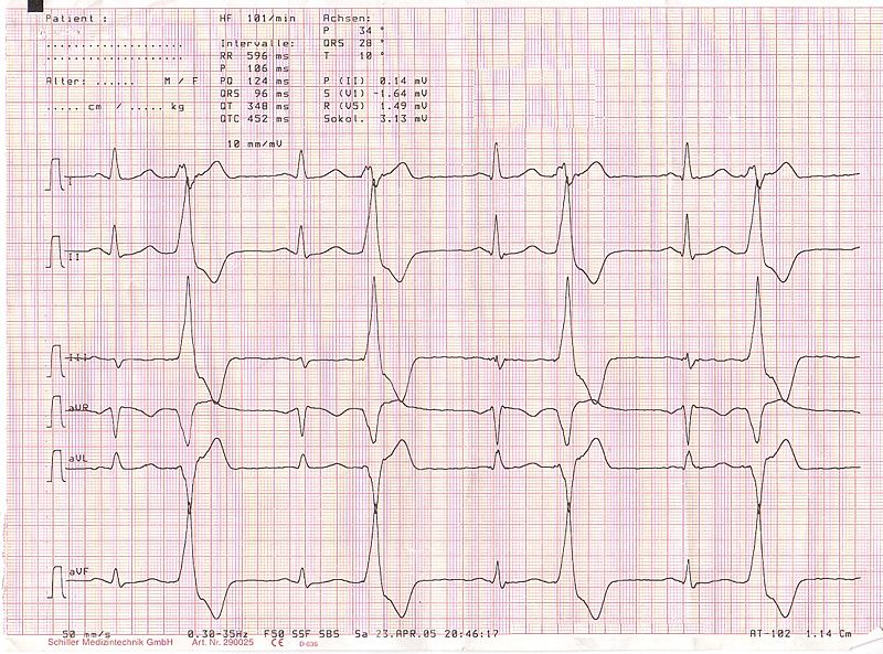 800px-Ekg_bigeminus_bionerd.jpg