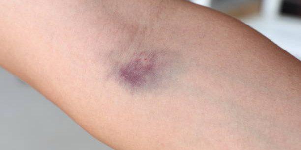 Bruise-612x306.jpg