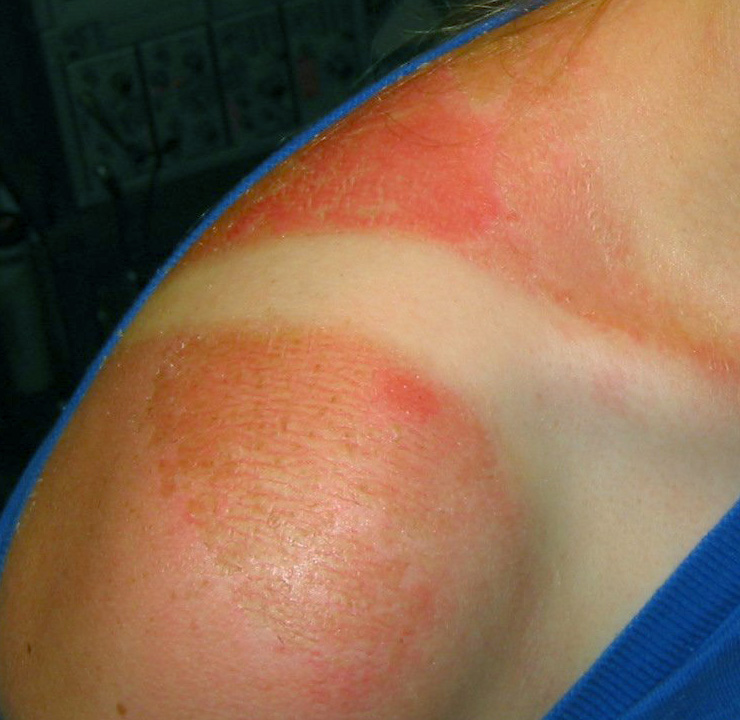 C:\Documents and Settings\J.H\Desktop\David's stuff\2007-05 (May)-20\Sunburn.jpg