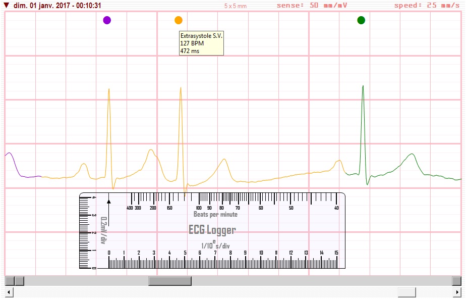 ECG.jpg