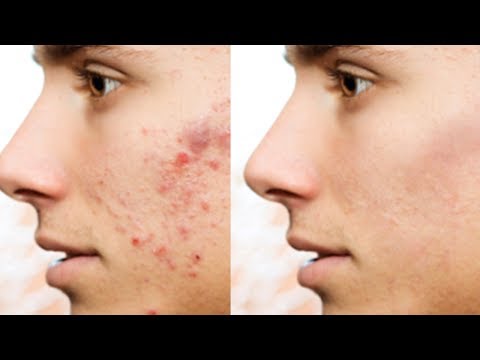 Imperfection Treatment (Acne Removal) - Photoshop Tutorial 3