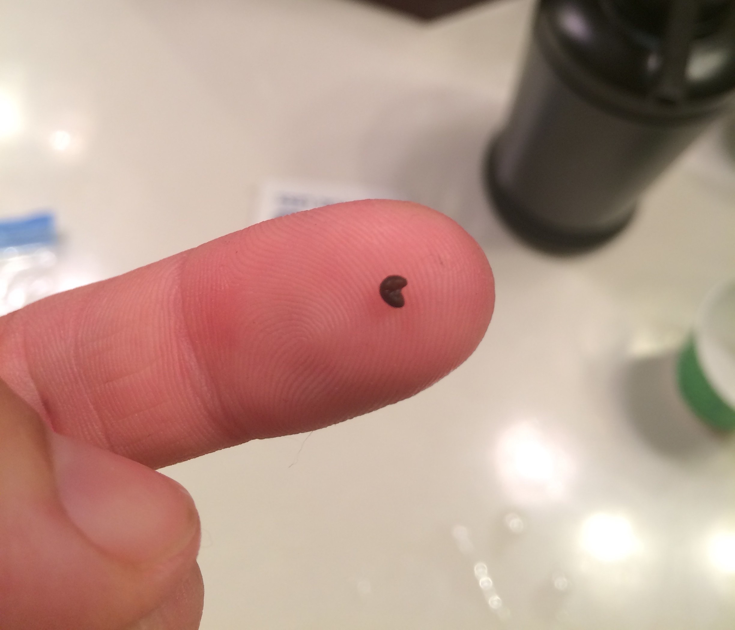 Kidney-stone.jpg