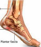 Plantar-Fasciitis1a.jpg