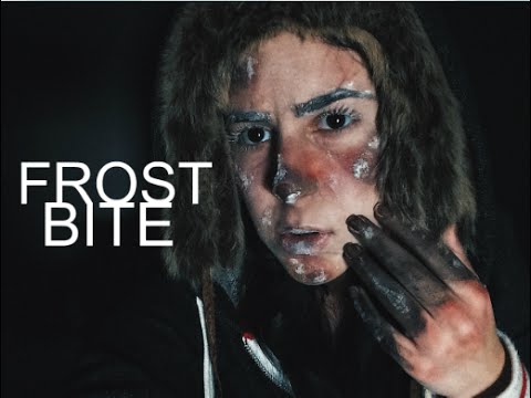 QUICK Frost Bite || + Frozen Fingers