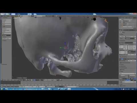 Stampa 3d di cranio da tac  (timelapse)