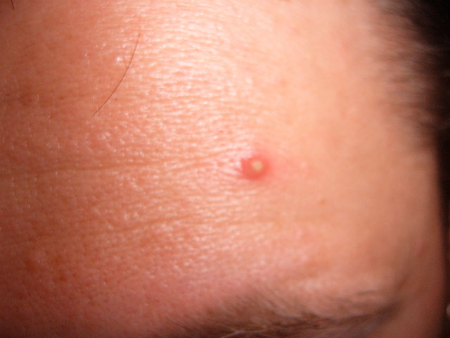 pimple[1].jpg