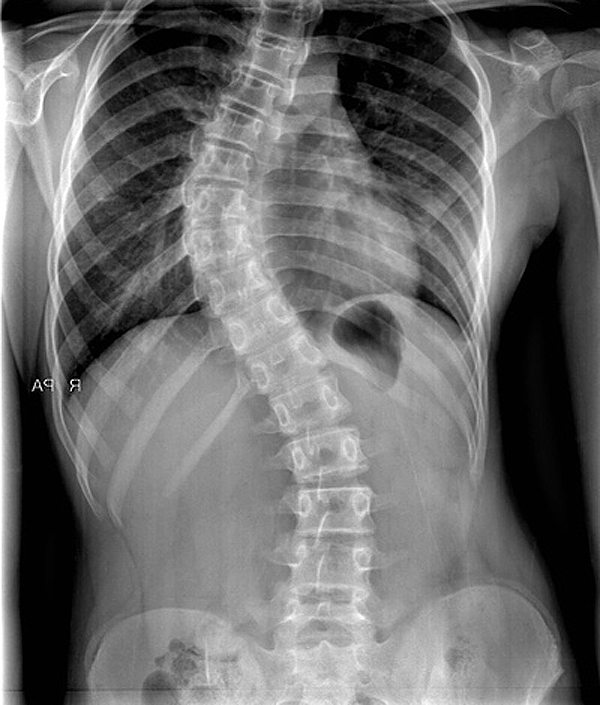 scoliosis2.jpg