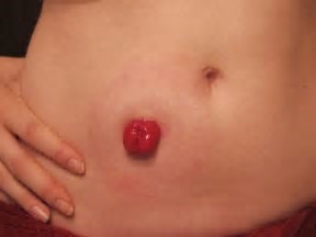 stoma2.jpg