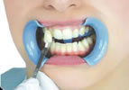 teeth-whitening-step2.jpg