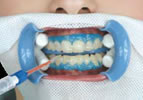 teeth-whitening-step3.jpg