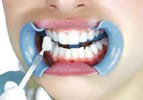 teeth-whitening-step5.jpg