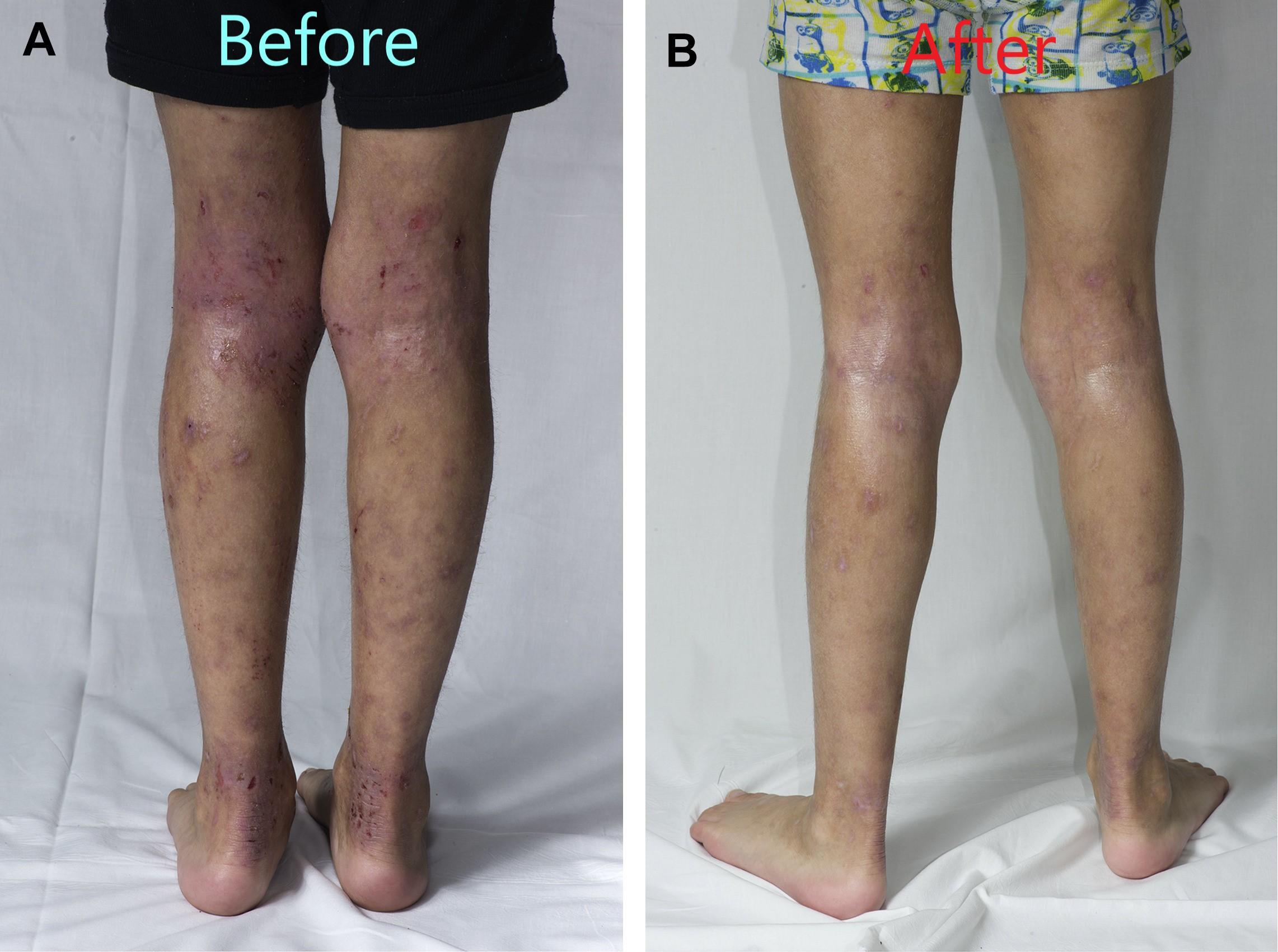Preventing Eczema: Wet Wrap Procedure